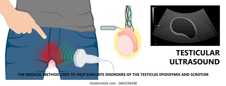 Testicular Disorder Men Vas Pus Tube Male Pain Cyst Test Exam Self Cord Vein Sperm Acute Blood Semen Tract Penis Viral Virus Tumor Fluid Testes Pelvic Sexual Penile Trauma System Prostate Testis