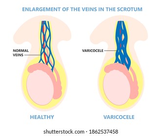 Testicular Disorder Men Vas Pus Tube Male Pain Cyst Test Exam Self Cord Vein Sperm Acute Blood Semen Tract Penis Viral Virus Tumor Fluid Testes Pelvic Sexual Penile Trauma System Prostate Testis