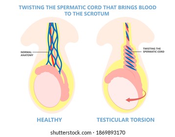 Testicular Disorder Men Vas Pus Tube Male Pain Cyst Test Exam Self Cord Vein Sperm Acute Blood Semen Tract Penis Viral Virus Tumor Fluid Testes Pelvic Sexual Penile Trauma System Prostate Testis