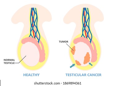 Testicular Disorder Men Vas Pus Tube Male Pain Cyst Test Exam Self Cord Vein Sperm Acute Blood Semen Tract Penis Viral Virus Tumor Fluid Testes Pelvic Sexual Penile Trauma System Prostate Testis