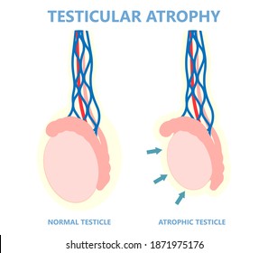 Testicular Disorder Men Vas Pus Tube Male Pain Cyst Test Exam Self Cord Vein Sperm Acute Blood Semen Tract Penis Viral Virus Tumor Fluid Testes Pelvic Sexual Penile Trauma System Prostate Testis