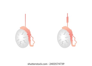 Testicular Torsion Disease Scientific Design. Vector Illustration.	