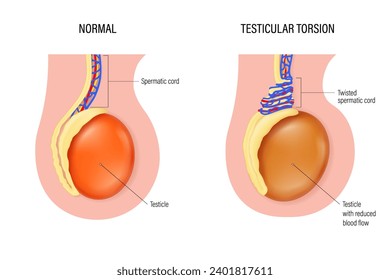 Testicular torsion vector. Comparison of normal and Testicular torsion. Testicular disease. male reproductive system.