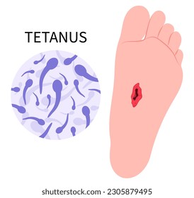 Tetanus infection bacteria Clostridium tetani virus bacterial toxin lockjaw Vaccination and vaccine prevention Stepped on a Nail trauma