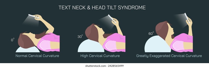 Text Neck Syndrome of phone posture is the onset of cervical spinal degeneration from excess look down at mobile screens. Aka Anterior head prevention. Cervical neck aches vector illustration. 