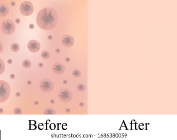 Textura con cicatrices de acné y acné. Antes de que la cicatriz desaparece. Fondo de la piel. Infografía. Ilustración del vector