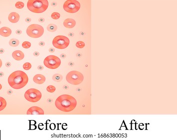 Texture, inflamed pimples and acne. Before After acne cysts. Skin background. Infographics. Vector illustration on isolated background.