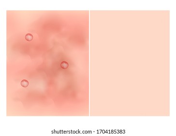 Texture, inflamed pimples and acne. Before After acne cysts. Skin background. Infographics. Vector illustration on isolated background.