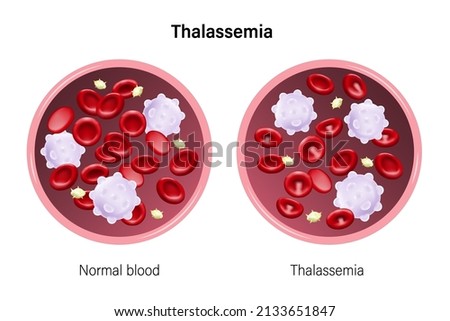 Thalassemia. The difference of blood thalassemia and normal blood. Red blood cells, White blood cells and platelets.