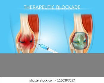 Therapeutic Blockage Realistic Vector Anatomical Scheme with Medicines Injection in Sick and Inflamed Knee Joint, Effect of Medical Therapy Illustration. Treatment of Joints Painful Diseases Chart
