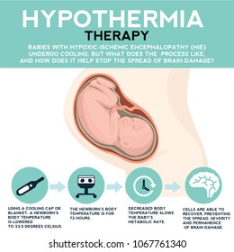Therapeutic hypothermia. Treatment for hypoxic ischemic encephalopathy , HIE. Detailed vector Infographic. Baby Health