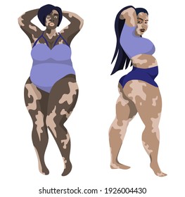 Thick beautiful vector Asian and African American women with vitiligo in blue lingerie isolated on white background. Beautiful skin with abnormalities. Any body is beautiful. Body positive.