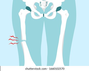 Thigh bone broken bone vertor illustration in x-ray style for Emergency accident concept.