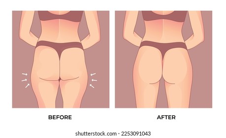 Thigh fat. Before and after weight loss, woman body shape transformation, Fat To Fit. 