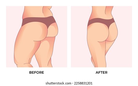 Thigh fat. Before and after weight loss, woman body shape transformation, Fat To Fit. 