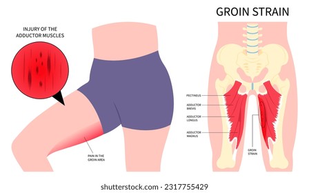 thigh pain injury Bursitis fracture in plexus flexion muscle with groin strain or hip lumbar rotation back and Obturator nerve externus lower the first aid of RICE Rest Ice stress torn