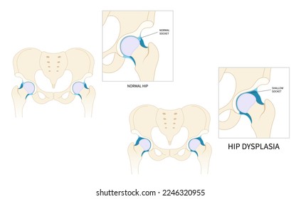 Thighbone joint dislocated broken pain of leg bone treat unstable femur pelvis chronic damage sport nerve sciatic compression labral tear child hurt thigh closed loose baby birth neck and prosthesis