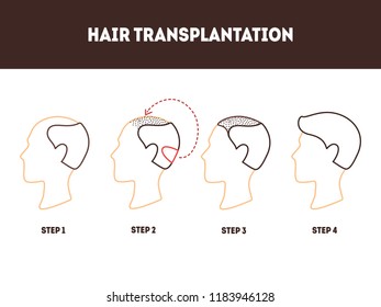 Thin Line Hair Transplant Surgery Card Poster Alopecia Transplantation Procedure and Growth Step Concept Design Style. Vector illustration