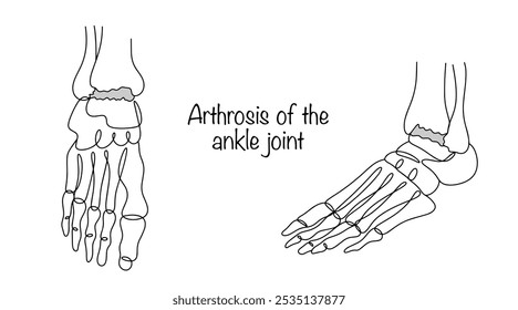 Thinning of the cartilage layer, which is often caused by deformations of the talus. The bones of the foot of a person with arthrosis of the ankle joint are drawn in different projections. Vector.