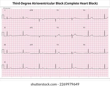 Third Degree Atrioventricular Block - ECG Paper 12 Lead - Electrocardiogram - Vector Medical Illustration