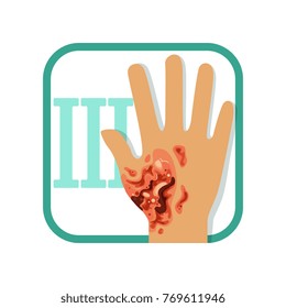 Third degree of burn. Hand with damaged outer (epidermis) and inner (dermis) layer of skin. Severe injury. Flat vector design for medicine book, poster or flyer