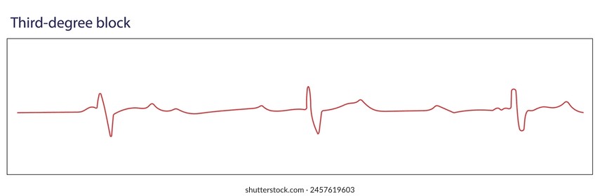 In a third-degree block, there is no correlation between atrial activity (the P wave) and ventricular activity (the QRS complex)