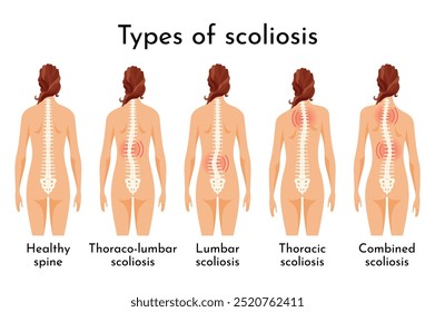 This article covers the different types of scoliosis affecting individuals of all ages