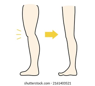 This is a before and after illustration of the elimination of the hated above-the-knee flesh.