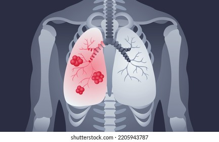 This colorful flat medical Illustration depicts a lung cancer, a body shape with a tumor in the lung