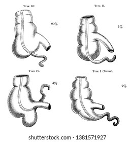 Dieses Diagramm stellt vier Arten von Cecum, Vintage-Linie Zeichnung oder Gravur-Illustration dar.