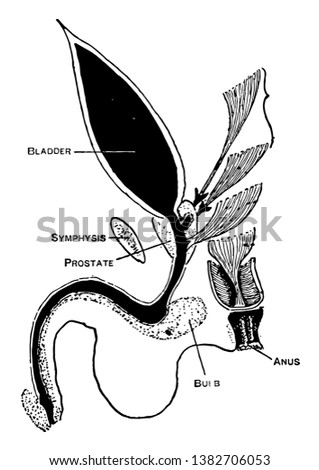 This diagram represents Imperforate Anus, vintage line drawing or engraving illustration.