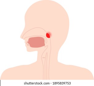 This Is An Illustration Of Adenoid Hypertrophy.