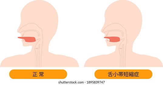 Esta es una ilustración de Anquiloglosia. [El japonés es Anquiloglosia.]