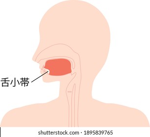 Esta es una ilustración de Anquiloglosia. [El japonés es Anquiloglosia.]