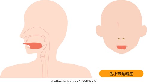 Esta es una ilustración de Anquiloglosia. [El japonés es Anquiloglosia.]