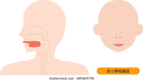 Esta es una ilustración de Anquiloglosia. [El japonés es Anquiloglosia.]