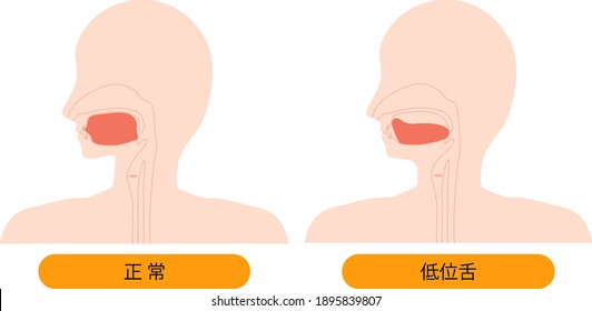 Esta es una ilustración de la posición correcta de la lengua y de la lengua baja. [El japonés es normal y la anquiloglosia.]