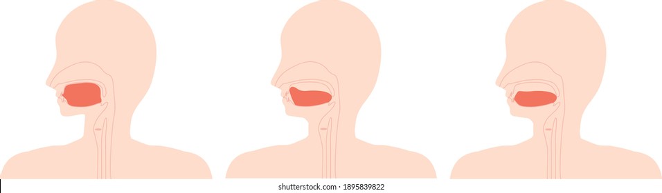 This is an illustration of the correct tongue position and low tongue.