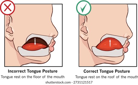 Esta es una ilustración de la posición correcta de la lengua y la lengua baja. Ilustración de stock