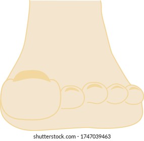 This is an illustration of a floating toe foot.