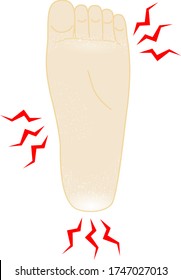 This is an illustration of an itchy foot with athlete's foot.