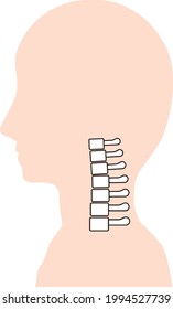 This is an illustration of a neck bone with cervical kyphosis.