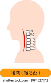 This is an illustration of a neck bone with cervical kyphosis. Japanese is Posterior curvature (cervical kyphosis).
