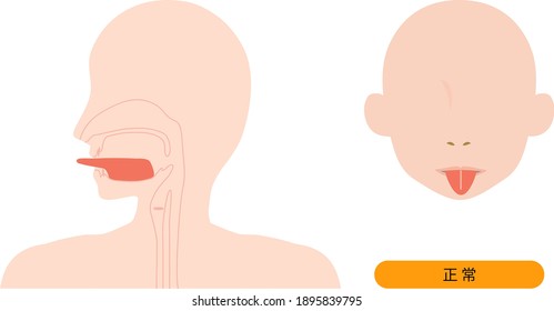 Esta es una ilustración de una lengua normal.[El japonés es normal.]