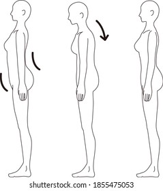 This is an illustration of poor posture.
(Hunchbacked / Thoracic spine)