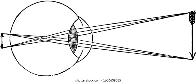 This illustration represents Cornea too Concave on Eye, vintage line drawing or engraving illustration.