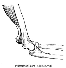 This illustration represents Fractured Olecranon, vintage line drawing or engraving illustration.