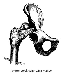 This illustration represents Hip Dislocation upon the Dorsum Illi, vintage line drawing or engraving illustration.