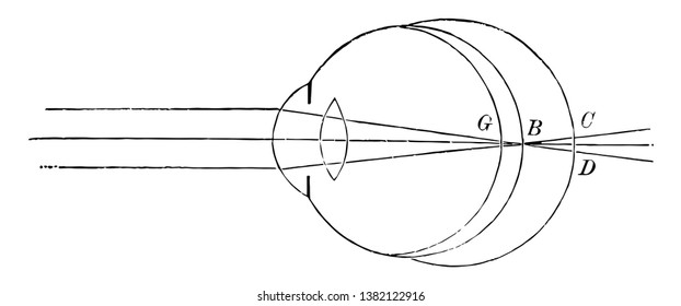 This illustration represents The Position of the Retina in Near and Far Sight, vintage line drawing or engraving illustration.