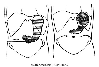 This illustration represents Stomach in a Bismuth-Laden Diet, vintage line drawing or engraving illustration.